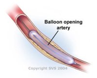 angioplasty; ballooning